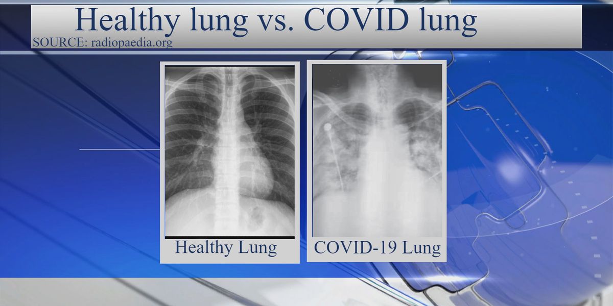 lungs covid-19