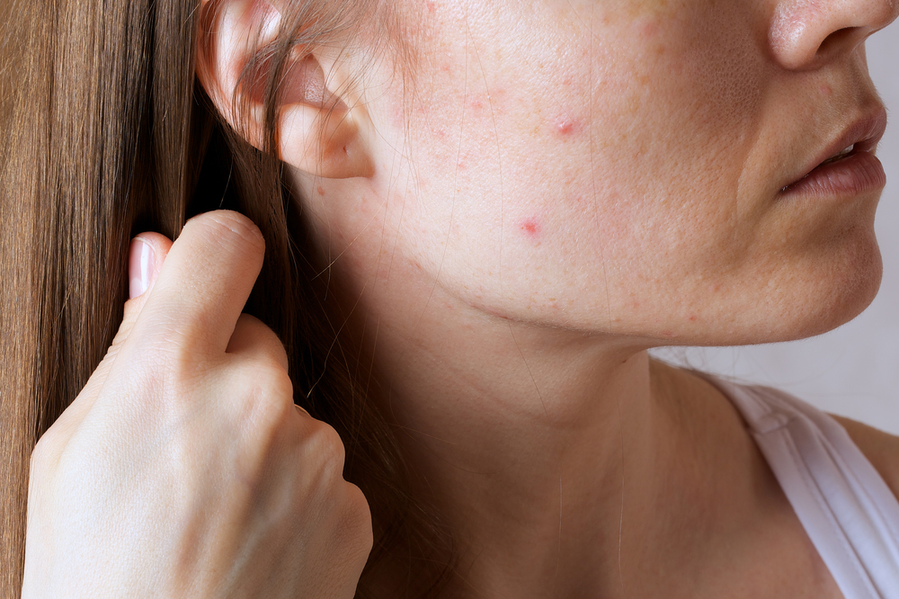 Diet to treat your acne and better your skin 
