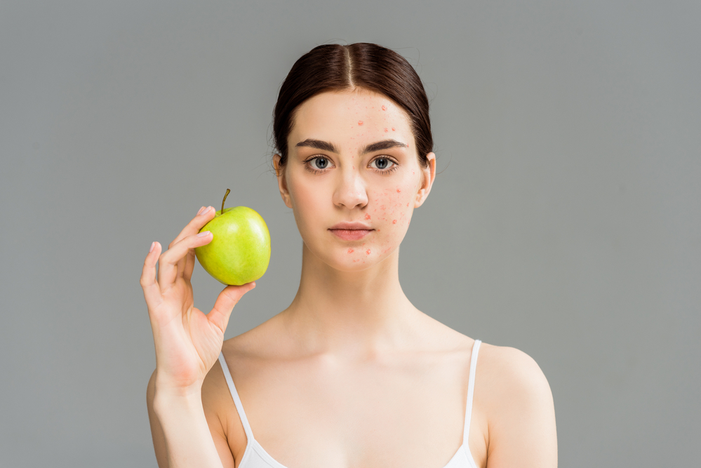 Diet to treat your acne and better your skin 